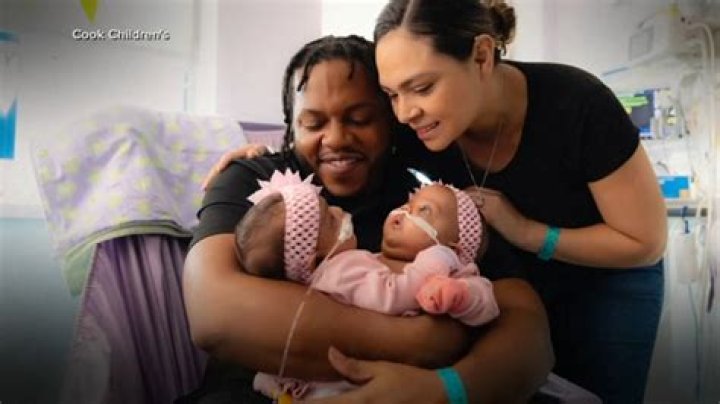 Unlocking The Secrets Of Jackie And Lola Anders Mason: Extraordinary Conjoined Twins